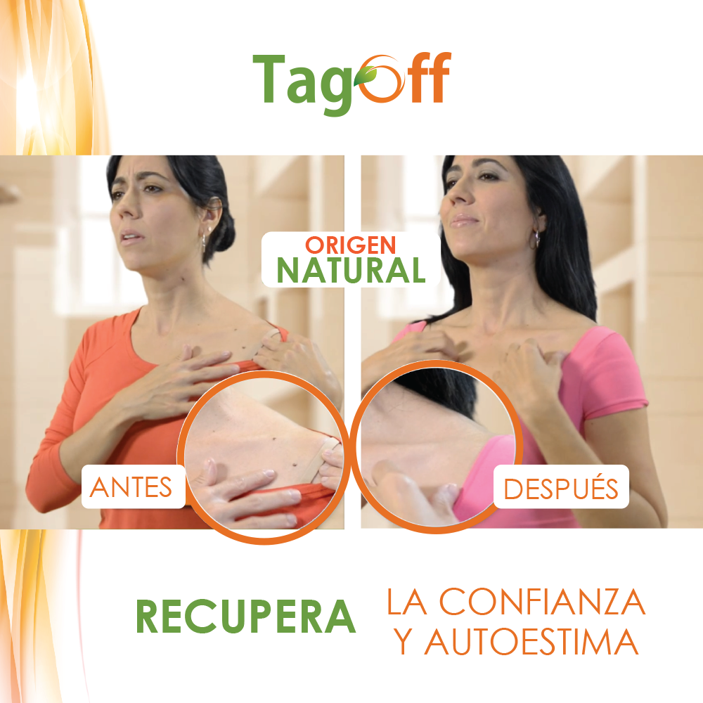 Tag Off Elimina Verrugas - Despídete de las verrugas y recupera tu seguridad personal